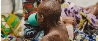 Mpox: أوغندا تبلغ عن 3 وفيات أخرى حيث بلغت الحالات المؤكدة 784