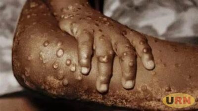 وزارة الصحة في أوغندا تفتح باب الرعاية المنزلية لمرض جدري القرود Mpox